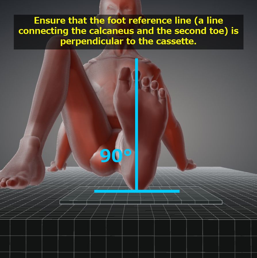 Xray Image Of Broken Heel Axial View Stock Photo - Download Image Now -  2015, Alternative Therapy, Anatomy - iStock