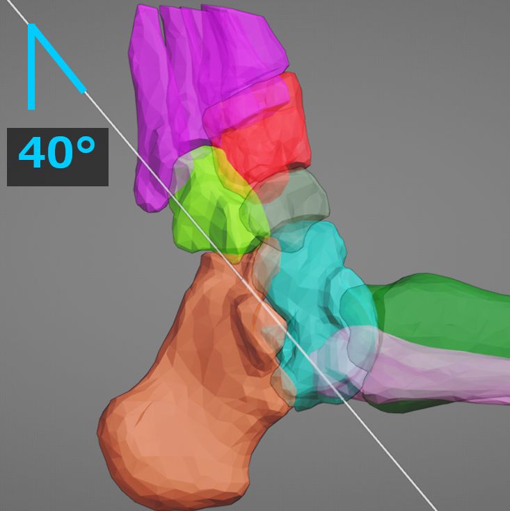 Radiographic evaluation: Harris heel view. Left is normal with parallel...  | Download Scientific Diagram