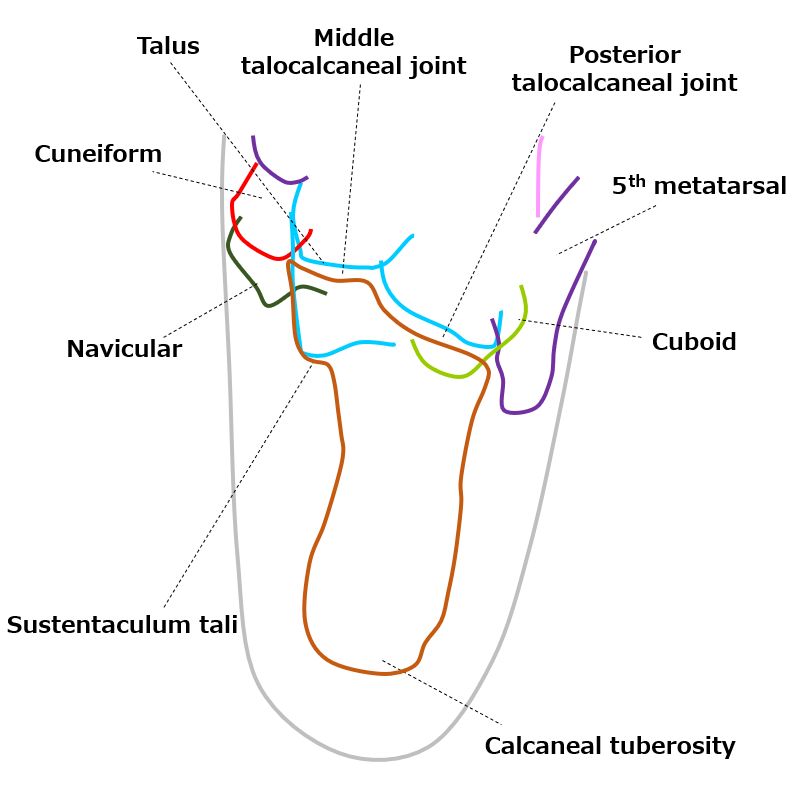 Intra-articular Calcaneal Fractures | SpringerLink